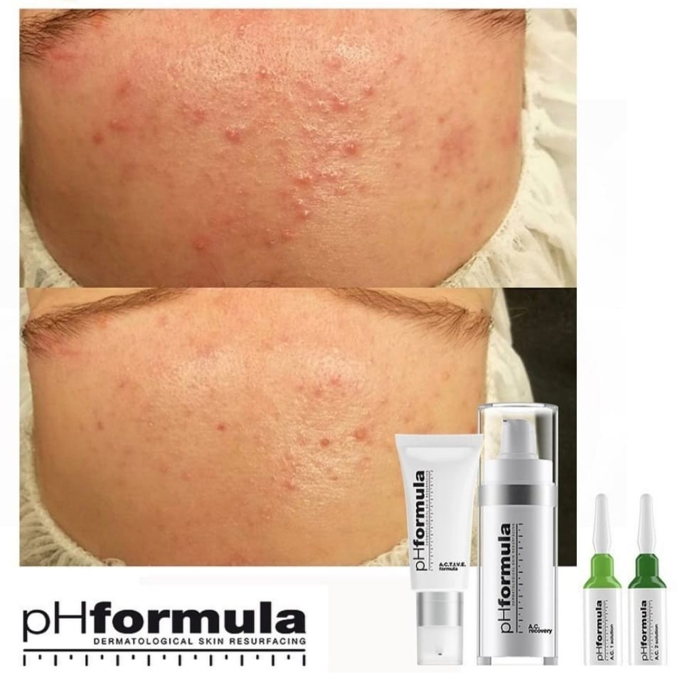 voor en na foto van acne behandeld met resurfacing