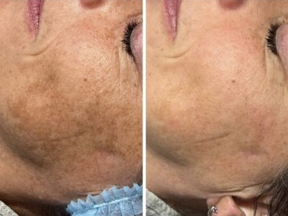 meline1